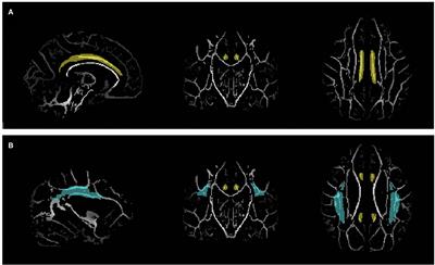 White Matter Correlates of Theory of Mind in Patients With First-Episode Psychosis
